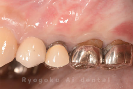 歯根端切除術の術後