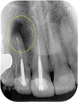 歯根端切除法の術後