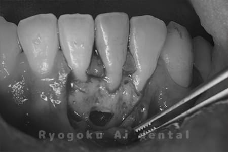 歯根端切除法術中1
