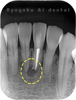 慢性根尖性歯周炎のレントゲン