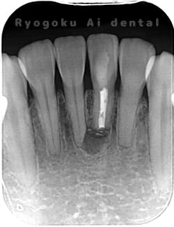 歯根端切除法の術後