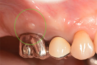 歯茎の腫れを確認