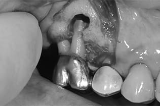 歯根端切除術１