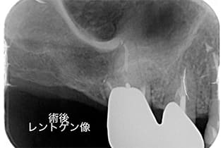 歯根端切除術３