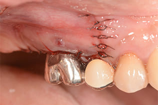 歯根端切除術４