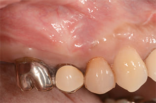 6ヶ月後に歯茎の腫れを確認