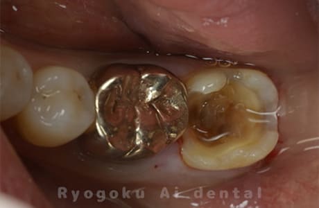 ゴールドクラウン術中