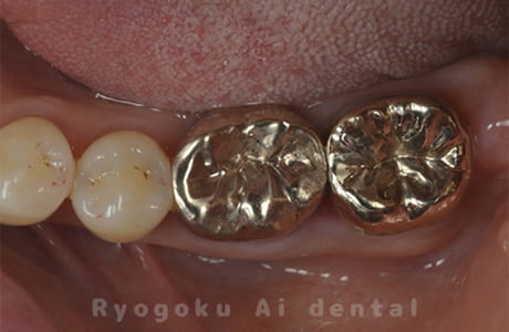 ゴールドクラウン