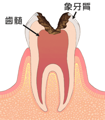 虫歯の後期
