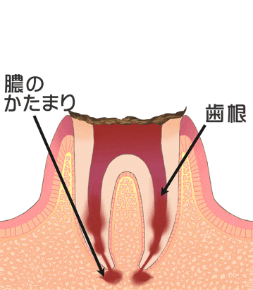 虫歯の後期