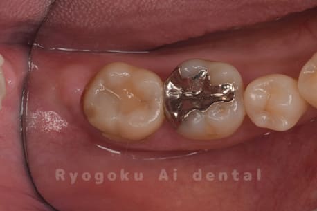 虫歯が歯茎の中まで及んでいるケース術前