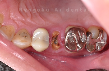 クラウン脱離、二次カリエス