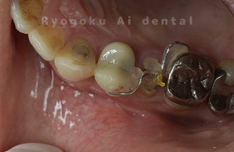 クラウンレングスニング術中２