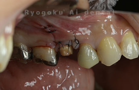 クラウンレングスニング術前１