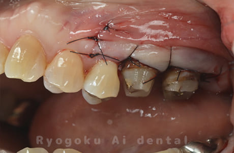 クラウンレングスニング術中