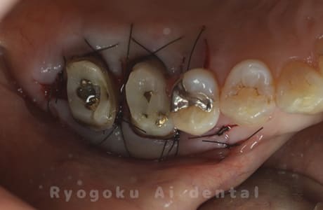 クラウンレングスニング術中