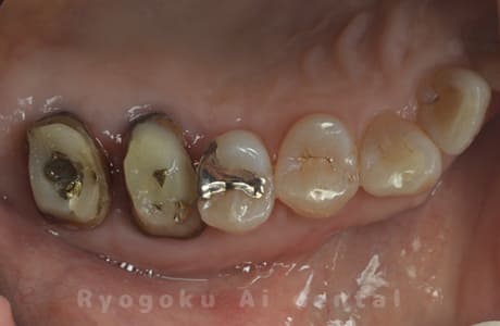 クラウンレングスニング術後