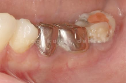 歯の状態や歯周病の状態を確認