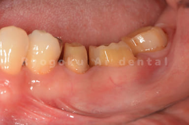 歯茎の手術