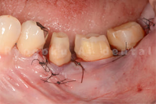 歯茎の手術
