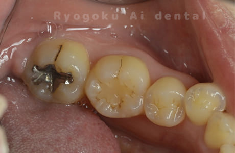 インレー二次カリエス