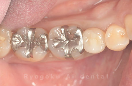 インレー２次カリエス