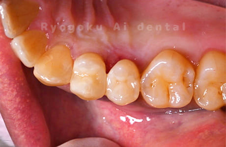 ダイレクトボンディング、セラミックインレー修復術後