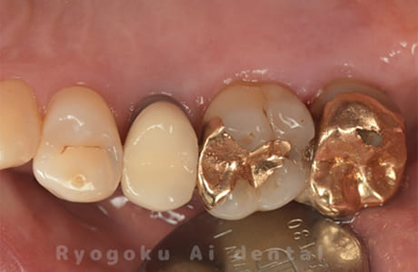 インレー2次カリエス、ゴールドクラウン2次カリエス