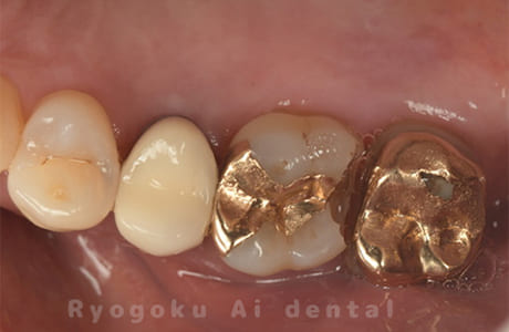 インレー2次カリエス、ゴールドクラウン2次カリエス