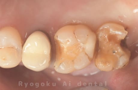 ゴールドインレー、ゴールドクラウン術中