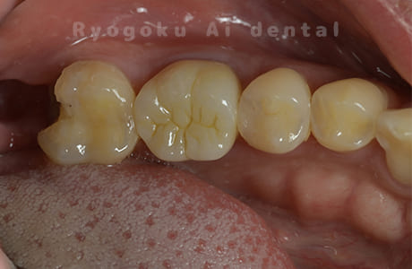 CR破折（プラスチック）