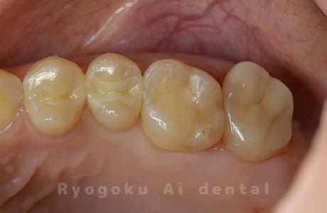 ジルコニアクラウン