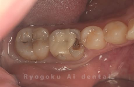 2次齲蝕