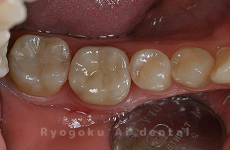 セラミッククラウン