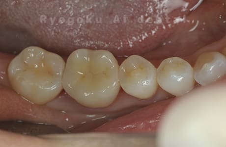 セラミッククラウン