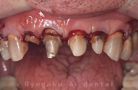 ダイレクトボンディング、セラミックインレー修復術後