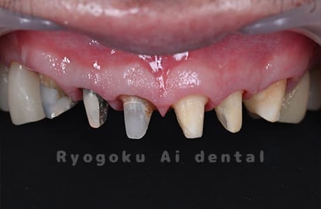 クラウンレングスニング術後