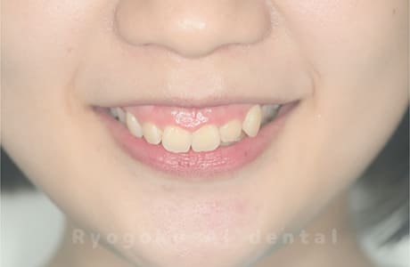 ガミースマイル改善治療術前正面