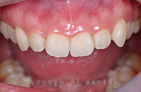 ガミースマイル改善治療術前口腔内