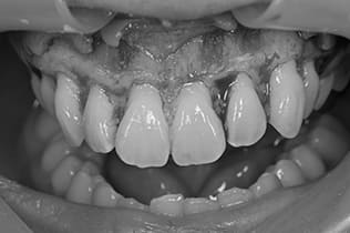 ガミースマイル改善治療手術１