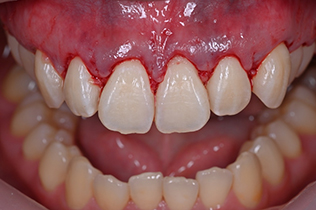 ガミースマイル改善治療手術３