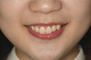 ガミースマイル改善治療術後１