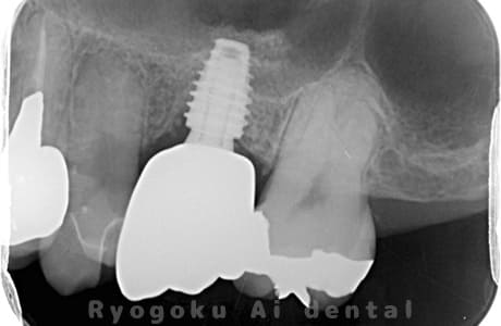インプラント治療レントゲン写真