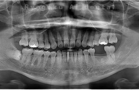 歯の欠損レントゲン