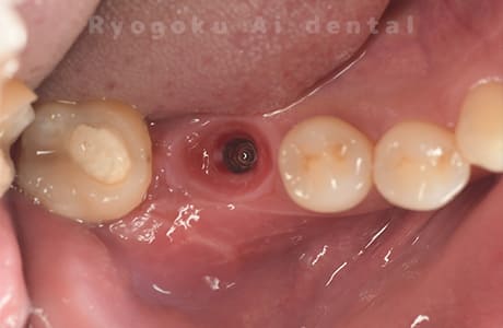インプラント埋入後