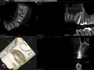 CT撮影と診断