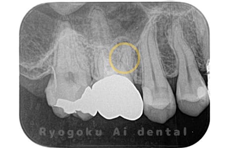 根管内異物（ファイル破折）による慢性根尖性歯周炎