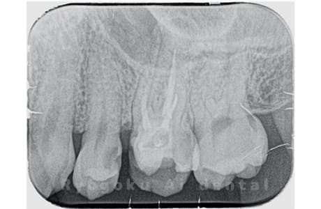 慢性根尖性歯周炎