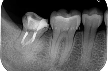 慢性根尖性歯周炎レントゲン写真術後