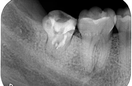 慢性根尖性歯周炎レントゲン写真術前